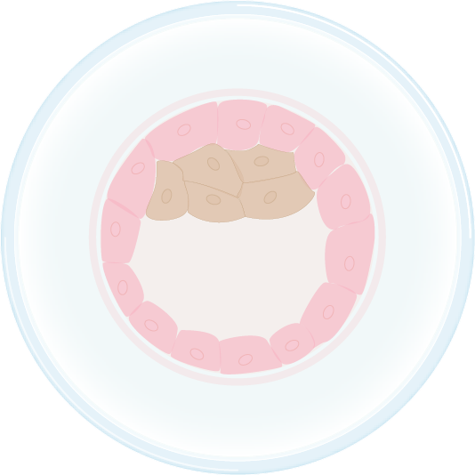 PGD Blastocyst